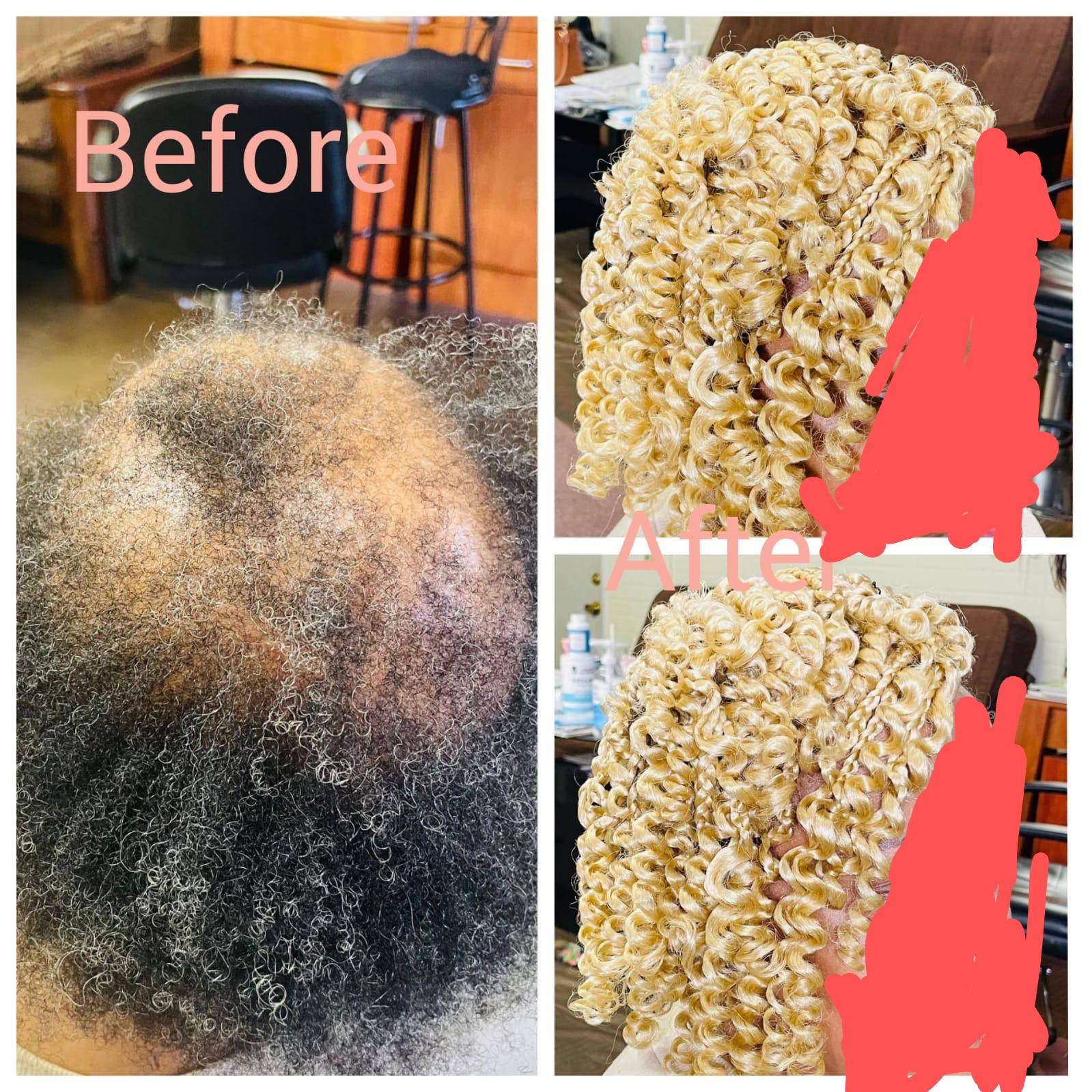 Alopecia Before and After